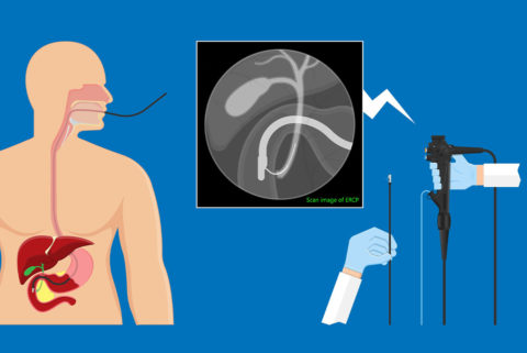 Endoscopies biliaires et pancréatiques - CPRE - Gastro-entérologue Lyon